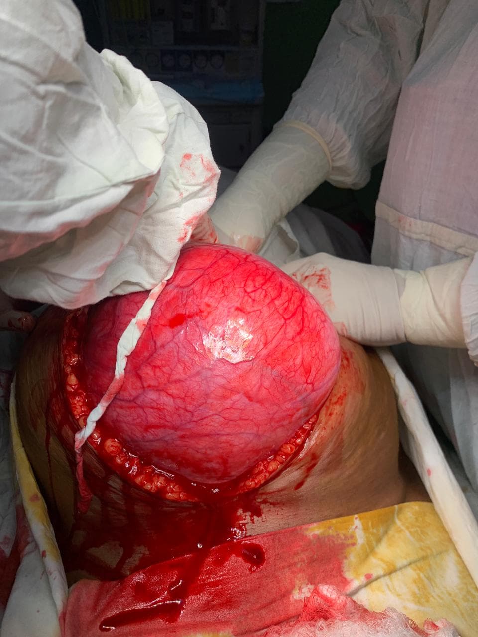 کراچی میں خاتون کے پیٹ سے15 کلو وزنی ٹیومر نکال لیا گیا