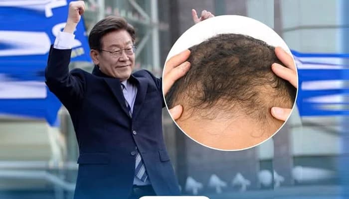 جنوبی کوریا کے صدر نے گنج پن کو ملک کیلئے سنگین مسئلہ قرار دیدیا