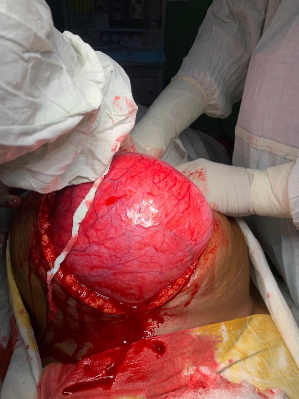 کراچی میں خاتون کے پیٹ سے15 کلو وزنی ٹیومر نکال لیا گیا