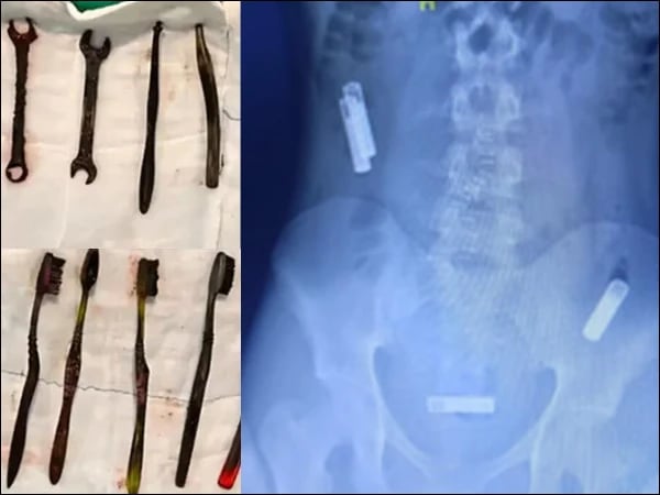 نوجوان کے معدے سے 7 ٹوتھ برش اور 2 لوہے کے پانے نکالے گئے